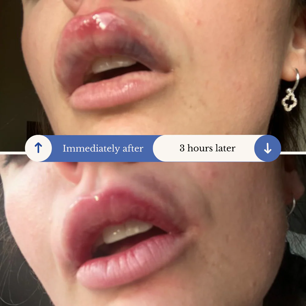 AfterMED LIPS - Image 3